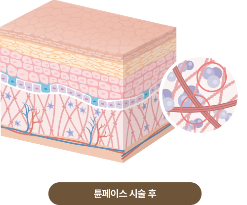 시술후