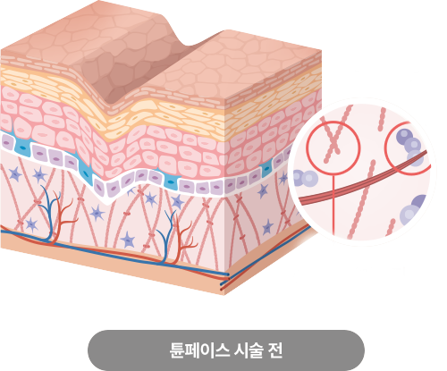 시술전